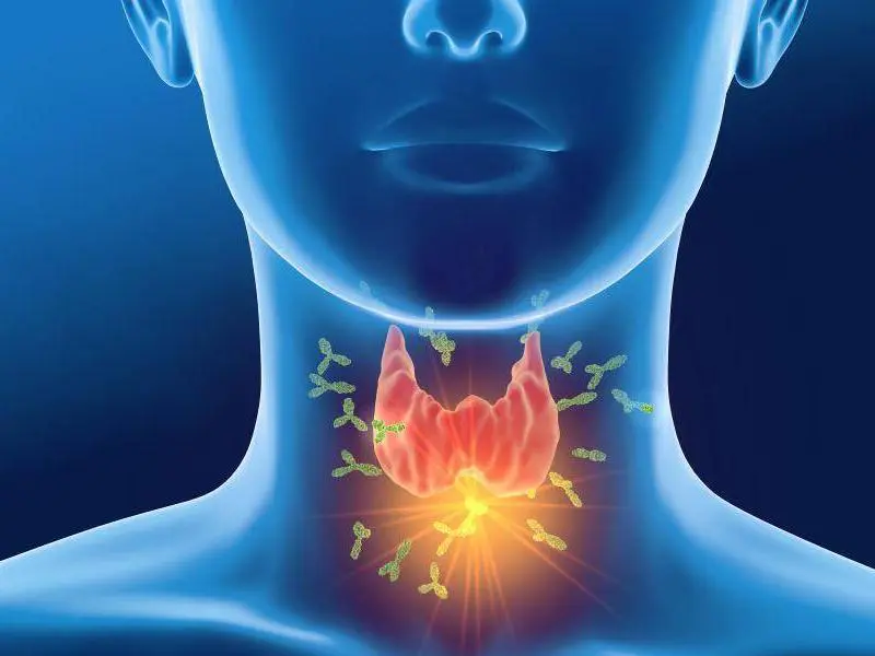 Hypothyroidism